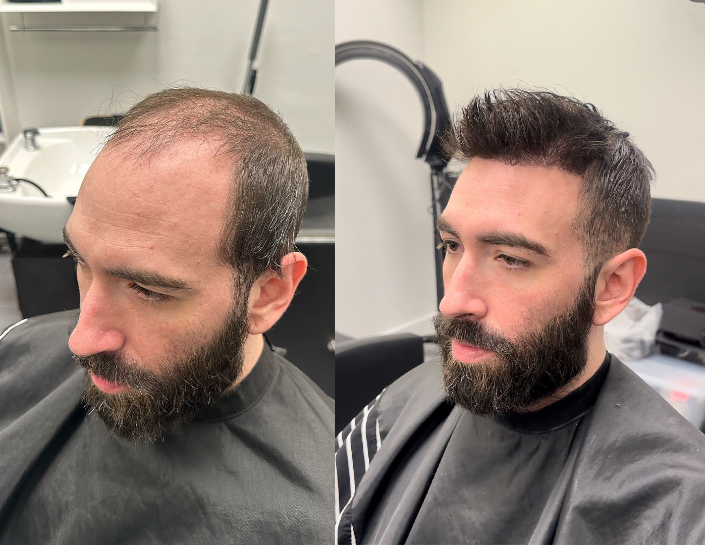 Non-surgical hair system before and after — JM Barber Co., Lake Park, FL Before-and-after hair system example — JM Barber Co., Lake Park, Florida